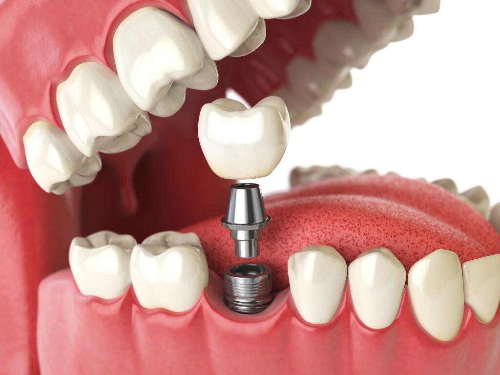 Dental-implant