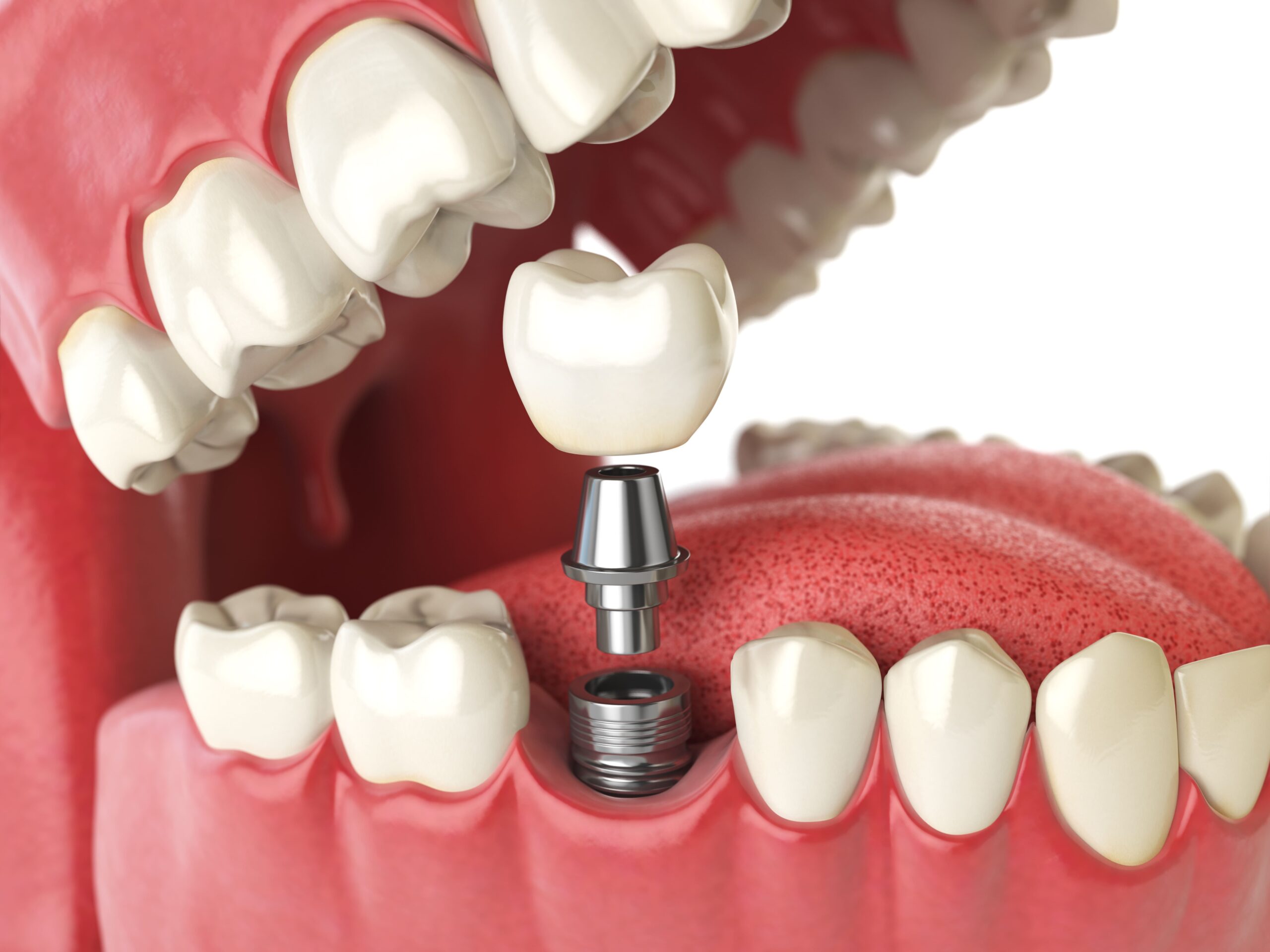 Dental-implant